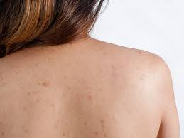 10 Ways to Get Rid of Back Acne At Home